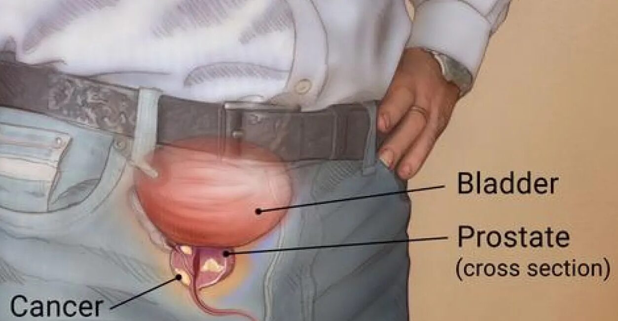 Prostate Cancer
